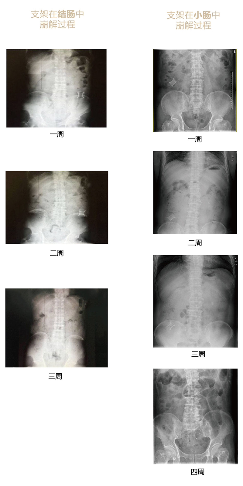 手術(shù)崩解過程x光片-01.jpg 手術(shù)崩解過程x光片-01.jpg